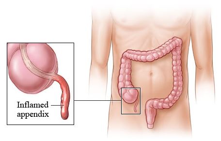Appendectomy may be performed to remove an inflamed appendix