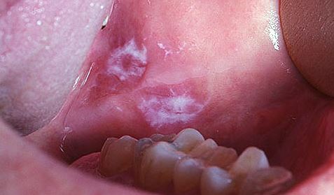 how to treat mouth ulcer