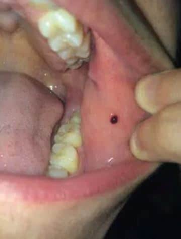 Dark Spot Inside Mouth 39