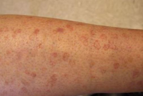 dry itchy patches on skin spreading dry itchy patches on skin spreading