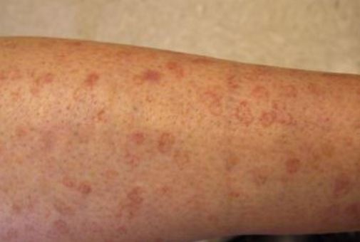 Light Brown Scaly Spots On Skin