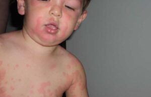 Chlorine Allergy Rash Pictures, Symptoms, Treatment and ...