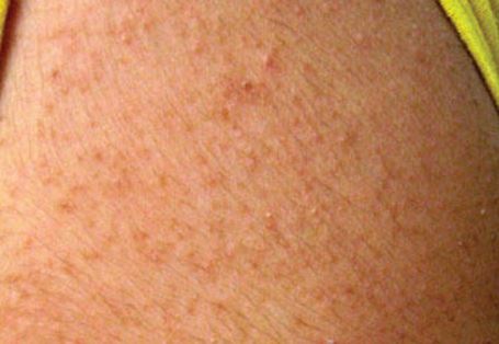 Dry heat lumps on back