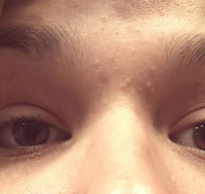 Pimple on Eyebrow, Under, Between, Near, Above, Swollen ...