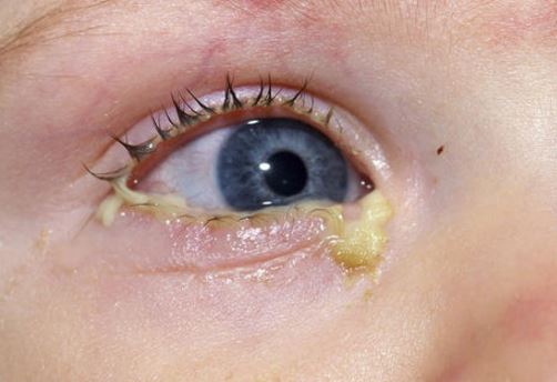 Pink-eye-may-cause-toddler-eye-discharge
