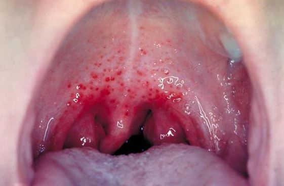 Allergies Throat Irritation 12