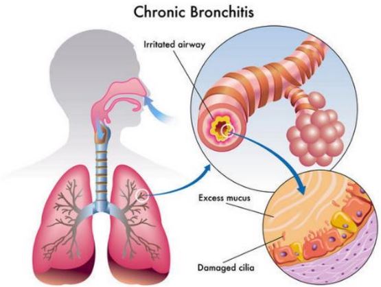 coughing up yellow mucus from chest sore throat dark in the how does mucus form