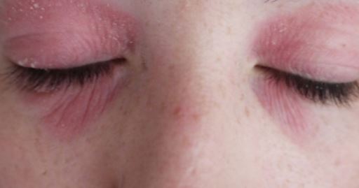 White Bump on Eyelid, Small, Under, Inside, on Lower Rim, Hard White