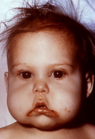 Anasarca causes and symptoms - Protein deficiency can lead to generalized edema in babies