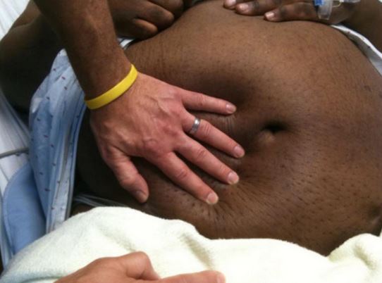 Causes of anasarca - Nephrotic Syndrome