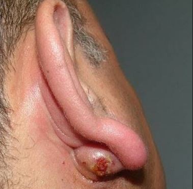 Infected cyst behind ear lobe