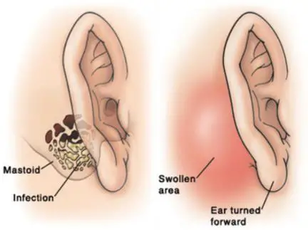 Mastoiditis