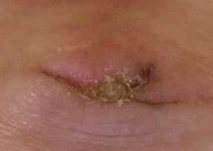 Scabbing belly button from discharge