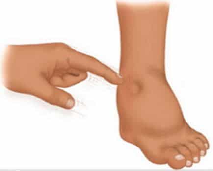 Symptoms of anasarca in pictures