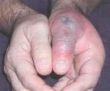 Camel spider bite pictures