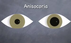 one pupil dilated suddenly
