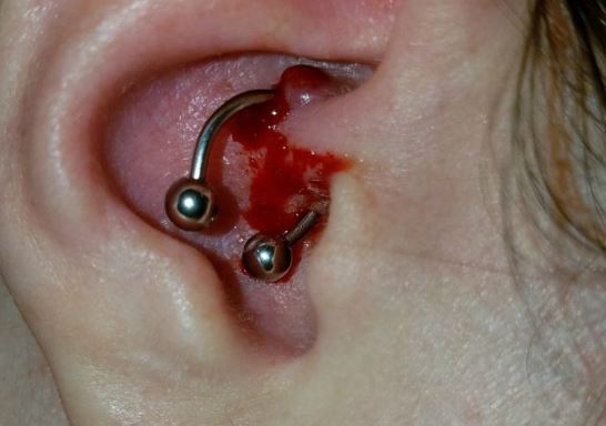 Bleeding daith piercing from infection.