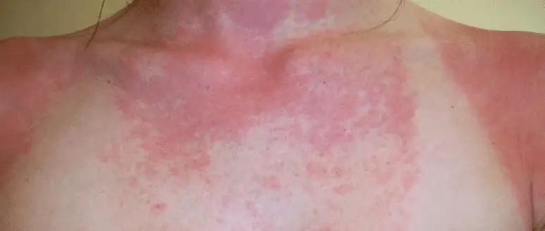 gabapentin sun rash